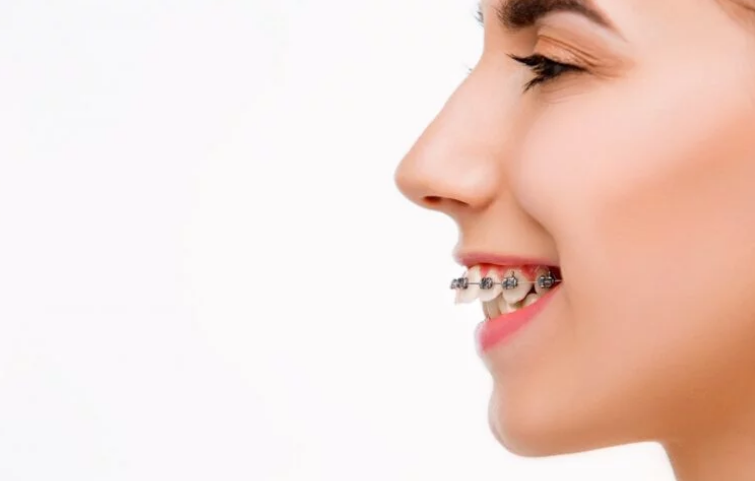 جلوزدگی دندان‌های جلویی بالایی یا اورجت
