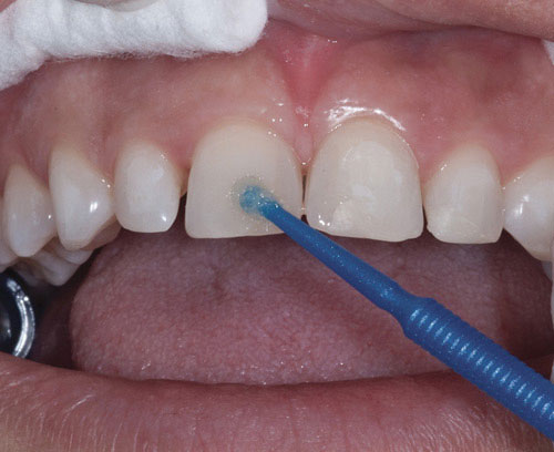 روش ادهزیو و بایوممتیک در دندانپزشکی